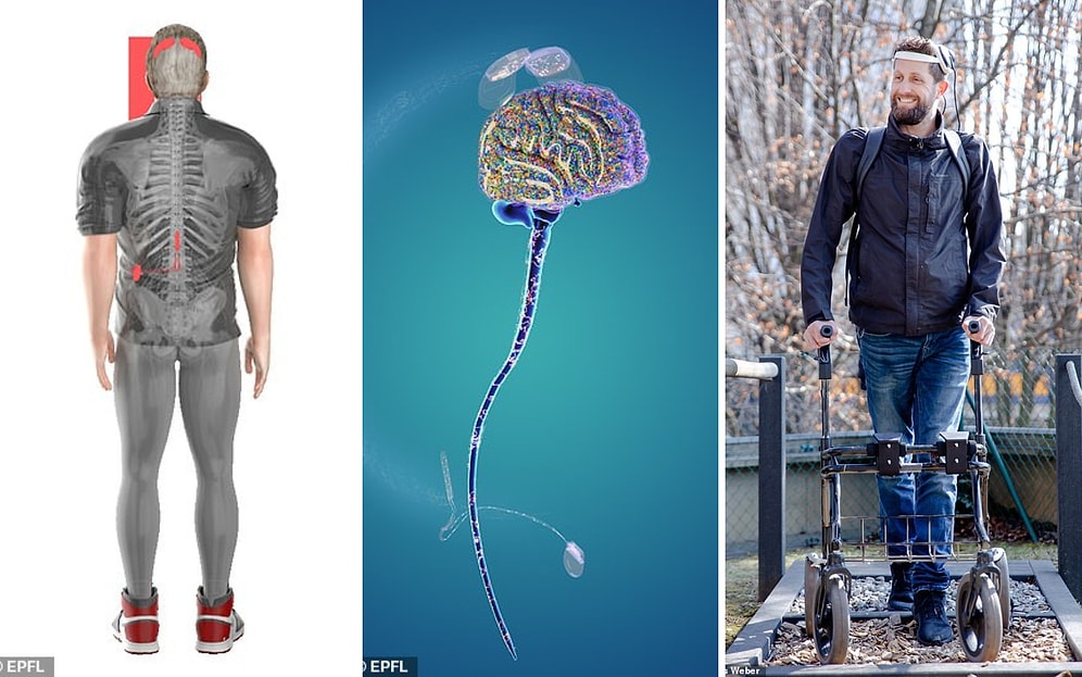 Парализованный мужчина впервые за 12 лет начал ходит после того, как ему вживили имплант, читающий мысли