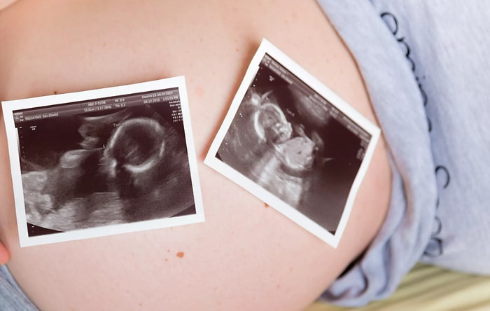 Женщина забеременела близнецами, и ее бесплодная сестра требует отдать одного ребенка