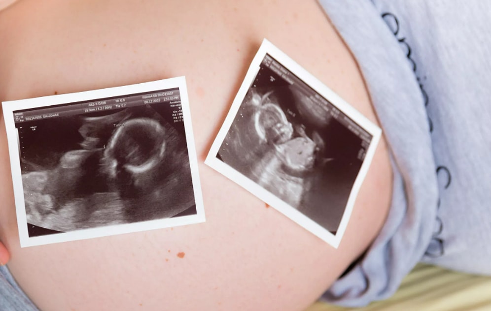 Женщина забеременела близнецами, и ее бесплодная сестра требует отдать одного ребенка