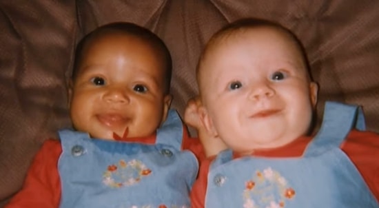 Девочки-близнецы с разным цветом кожи: как они выглядят, став взрослыми