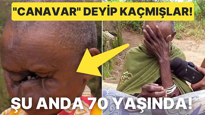 Görenler Kaçıyormuş: Doğuştan Gelen Bir Tümör Nedeniyle Ağzı Hariç Yüzündeki Tüm Organlarını Kaybeden Kadın!