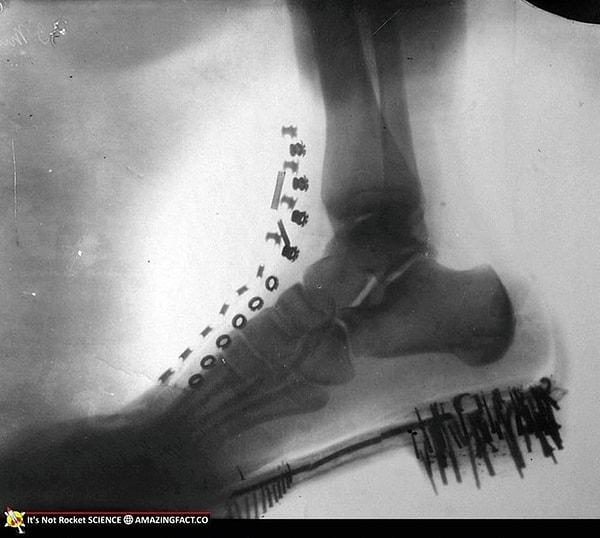 11. Nikola Tesla'nın 1896'da kendi tasarımı bir cihazla çektiği ayağının röntgeni 👇