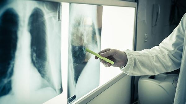 Tıp dünyasında akciğer kanserinin tedavisi için yapılan çalışmalar sürüyor. Bunlardan bir tanesi de son araştırmalarda keşfedilen bir akciğer kanseri ilacının ölüm riskini yarı yarıya azaltması buluşu oldu.