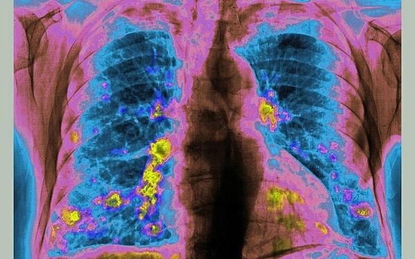 26 ülkede 30 ila 86 yaşları arasındaki hastaları kapsayan araştırmada ilacın akciğer kanseri hastalarına yardımcı olup olamayacağına bakıldı ve sonuçlar oldukça umut verici olarak nitelendirildi.