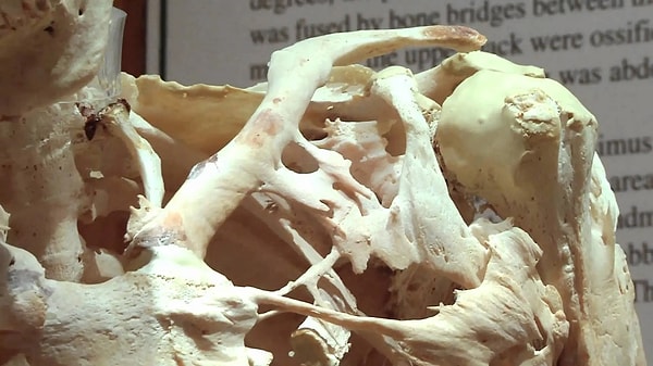 7. Существует редкое и тяжелое генетическое заболевание, известное как прогрессирующая оссифицирующая фибродисплазия.