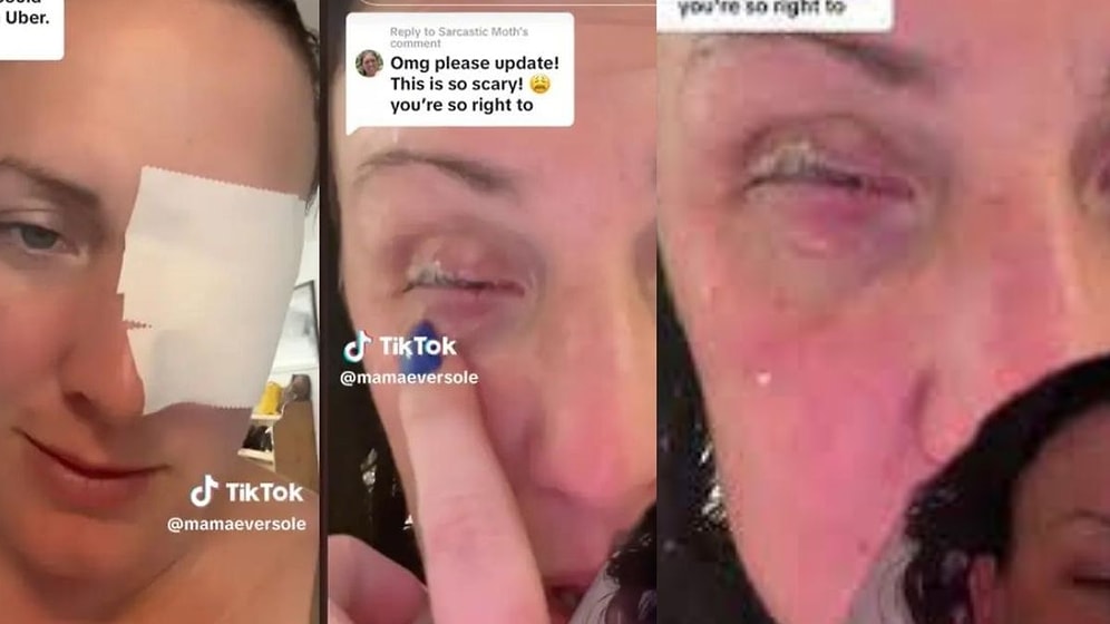 Gözüne Damla Yerine Yapıştırıcı Döktü!