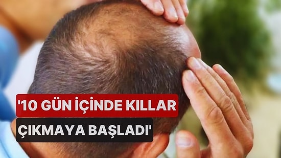 Genetik Bilimciler Açıkladı: Kelliğin Çaresi Bulundu!