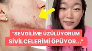 Yüzünde Sivilce Sorunu Yaşayan Koreli Kadına Yapılan Pervasız Yorum Hepinizi Çileden Çıkaracak!