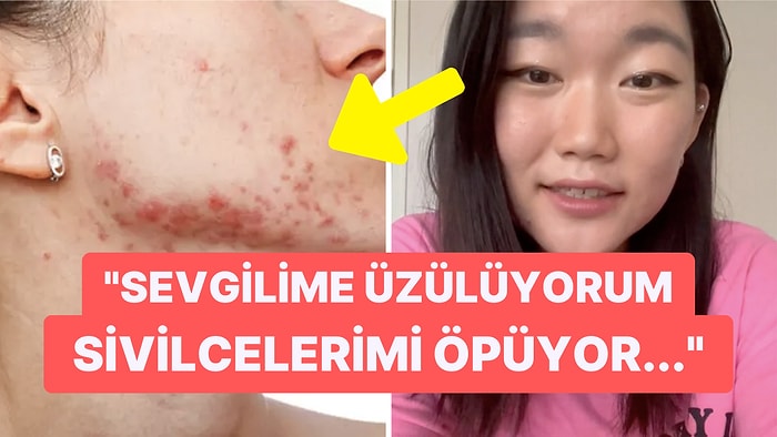 Yüzünde Sivilce Sorunu Yaşayan Koreli Kadına Yapılan Pervasız Yorum Hepinizi Çileden Çıkaracak!