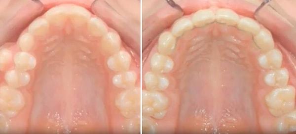 O videoda 2 yıllık bir diş teli kullanımı görülürken, dişler de zaman içerisinde oldukça düzgün bir hale geliyor.