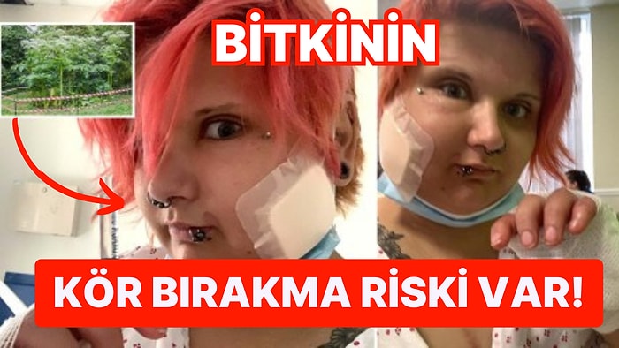 Yeni Fobi Açıldı: Kazara Bir Bitkiye Dokunduktan Sonra Balon Gibi Şişen Kadın Ölümden Döndü!