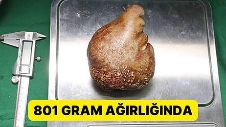 62 Yaşındaki Hastanın Böbreğinden 801 Gram Ağırlığında Taş Çıkarıldı