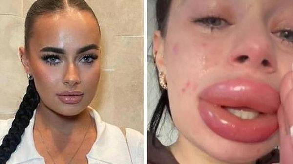 10- İnternette bir doktor tarafından düzenlenen çekilişte bedava dudak dolgusu işlemi kazanan sosyal medya fenomeni, hayatının pişmanlığını yaşadı.
