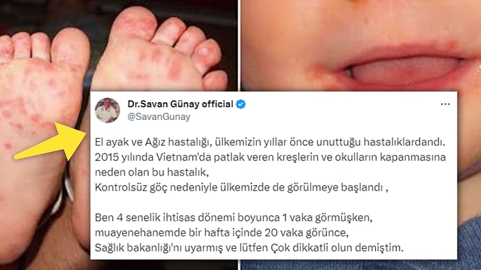 Sebebi "Düzensiz Göç" Olabilir mi? Son Zamanlarda Artan "El Ayak Ağız Hastalığı" Endişelendirdi!