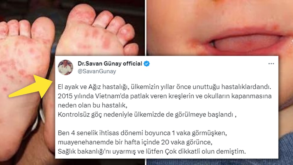 Sebebi "Düzensiz Göç" Olabilir mi? Son Zamanlarda Artan "El Ayak Ağız Hastalığı" Endişelendirdi!