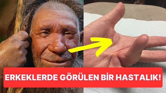 Neandertallerden İnsanlara Aktarıldığı Ortaya Çıkan Viking Hastalığına Siz de Yakalanmış Olabilirsiniz!