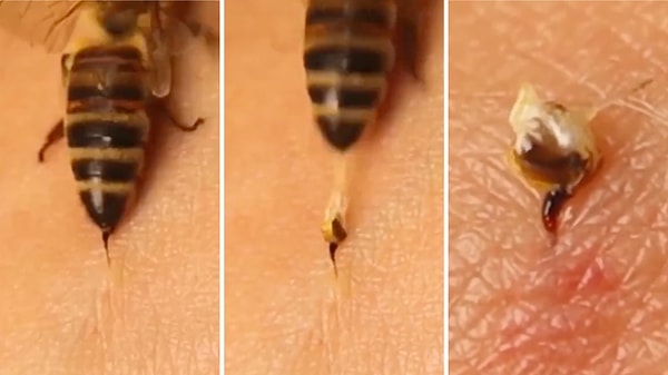 Bir arı sokması durumunda tam olarak neler yaşandığı kısa bir video ile anlatılmış.