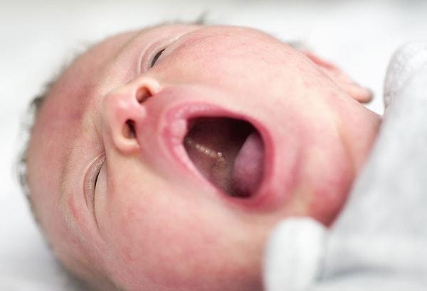 Bebeklerin ağzında ve dilinde çıkan küçük lezyonlar pamukçuk olarak tanımlanıyor. Bebeklerin bağışıklığı tam gelişmediği için bu tür enfeksiyonlar görülebiliyor.