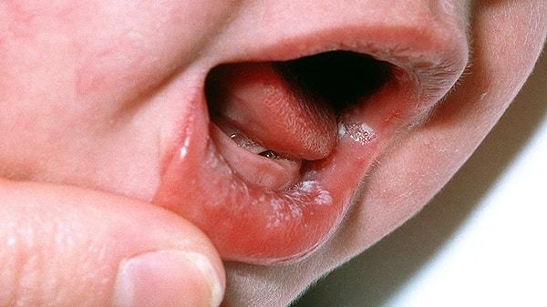 Pamukçuk bebeklerde sık görülebilen bir enfeksiyon türü. Candida adlı mantarın neden olduğu bu enfeksiyon bebeklerin ağzında, dilinde ve dudaklarında çıkabiliyor.