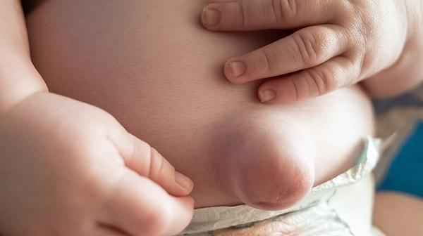 Bebeklerde göbek fıtığı doğum sonrası çok sık görülüyor. Bebeklerin göbek deliklerindeki kaslar yeterince güçlenmediğinden bağırsaklar veya karın zarı bu bölgeden dışarı çıkabiliyor.