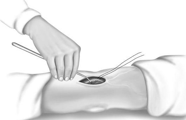 2. Как называется вскрытие просвета вены при помощи надреза?