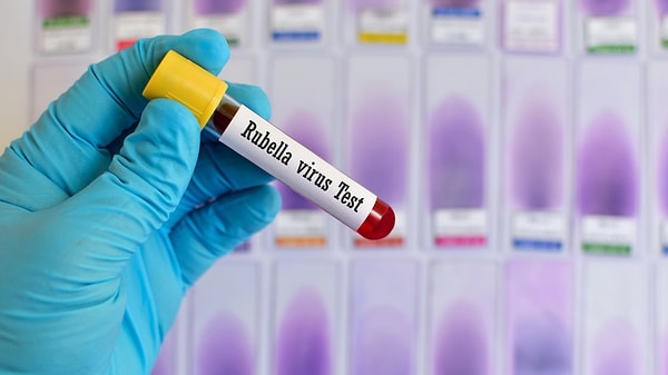 Anti Rubella IgG testi ne zaman yapılmalıdır?