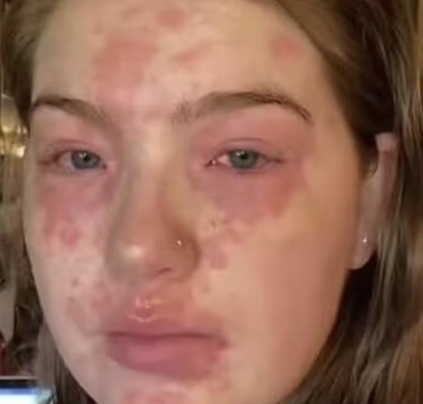 «Через неделю после того, как мы провели несколько дней в его доме, мы действительно заметили, что мое тело было невероятно красным, и я чувствовала себя очень плохо в течение следующих нескольких дней».