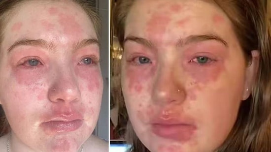 22-летняя девушка рассказывает, что у нее аллергия на своего парня: ее тело покрывается красными пятнами после их близости