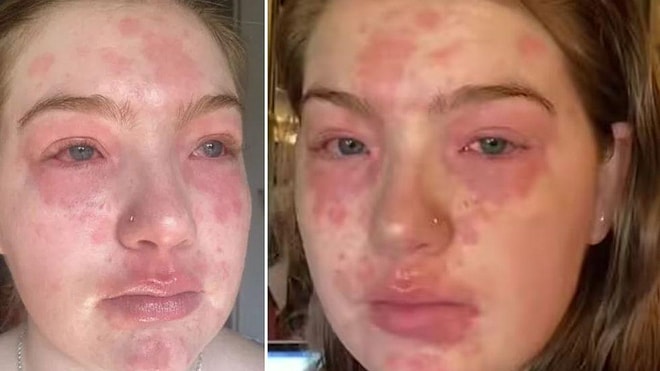 22-летняя девушка рассказывает, что у нее аллергия на своего парня: ее тело покрывается красными пятнами после их близости