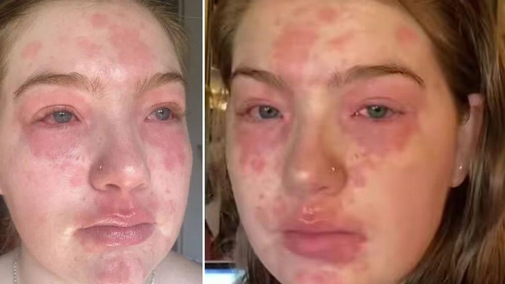 22-летняя девушка рассказывает, что у нее аллергия на своего парня: ее тело покрывается красными пятнами после их близости