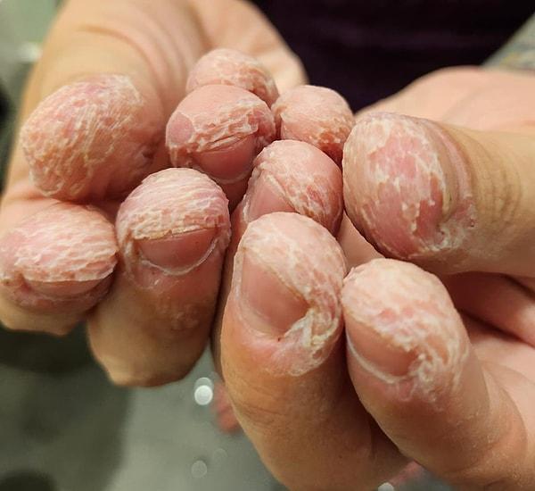 6. "Yıllarca ısırarak kopardığım parmaklarım banyoya girdikten sonra böyle görünüyor."
