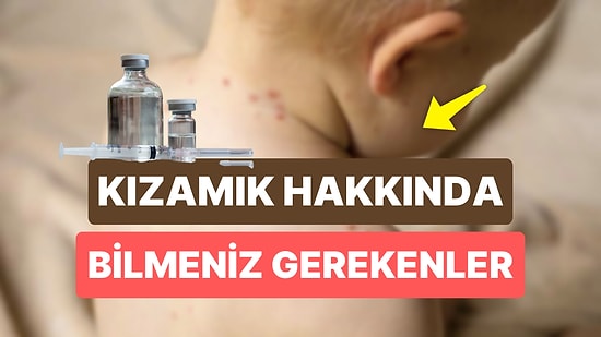 Kızamık Aşısı Ne Zaman Yapılır? Kızamık Nedir, Belirtileri Neler?