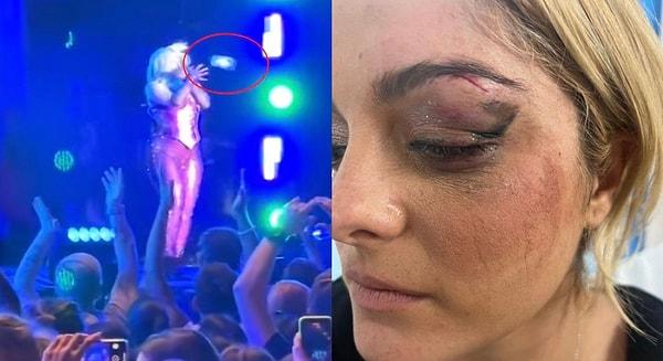 Geçen ay Bebe Rexha'nın yüzüne bir seyirci cep telefonu atmıştı. Arnavut asıllı Amerikan şarkıcı yaralanmış ve yüzüne dikiş atılmıştı.