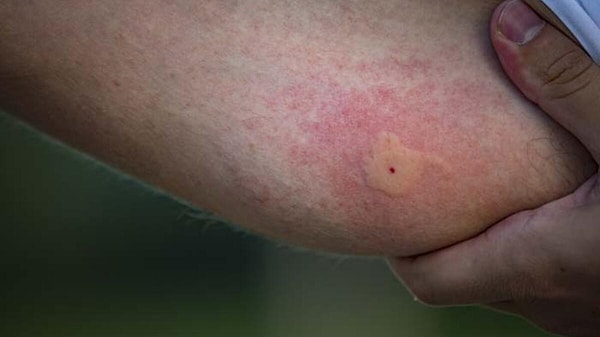 Ayrıca bu yeni sivrisinek türünün sarı humma ve zika gibi virüsleri bulaştırma potansiyeline de sahip olduğu kaydediliyor.