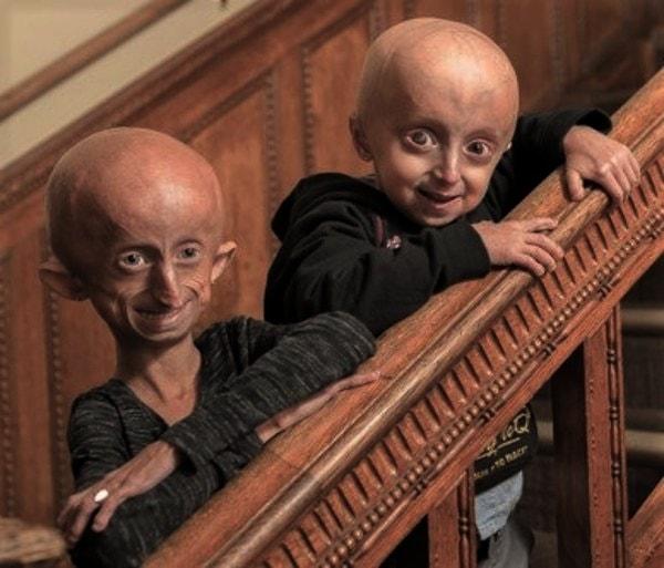 3. Hutchinson-Gilford Progeria Sendromu (HGPS)