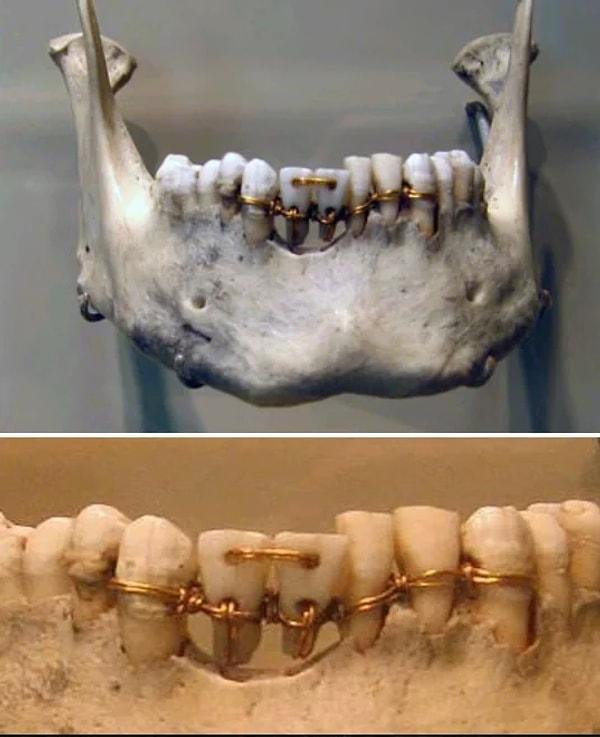 Bundan yıllar önce de dişçilik adına uygulamalar bulunsa da günümüz şartlarına yakın bile değildi.