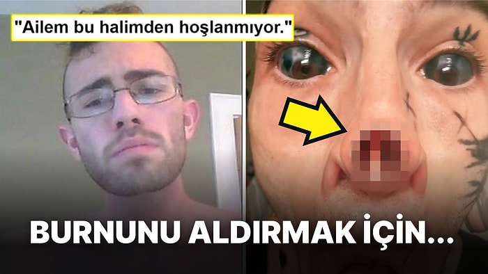 Meme Ucuyla Birlikte Burnunu da Aldırdığı İçin Zorbalığa Uğradığını Söyleyen Adamın İlginç Hikayesi