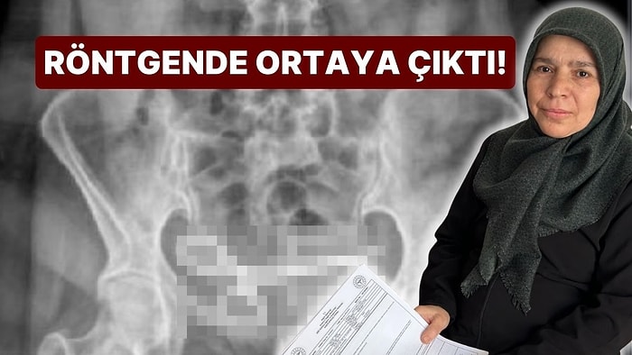 Karın Ağrısı Şikayetiyle Hastaneye Gitti, 8 Ay Karnında Taşıdığı Şey Şoke Etti!