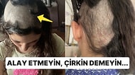 Psikolojik Travma Geçiren İnsanlarda Görülen Saç Yolma Hastalığı Nedir?