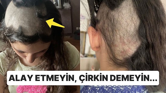 Psikolojik Travma Geçiren İnsanlarda Görülen Saç Yolma Hastalığı Nedir?