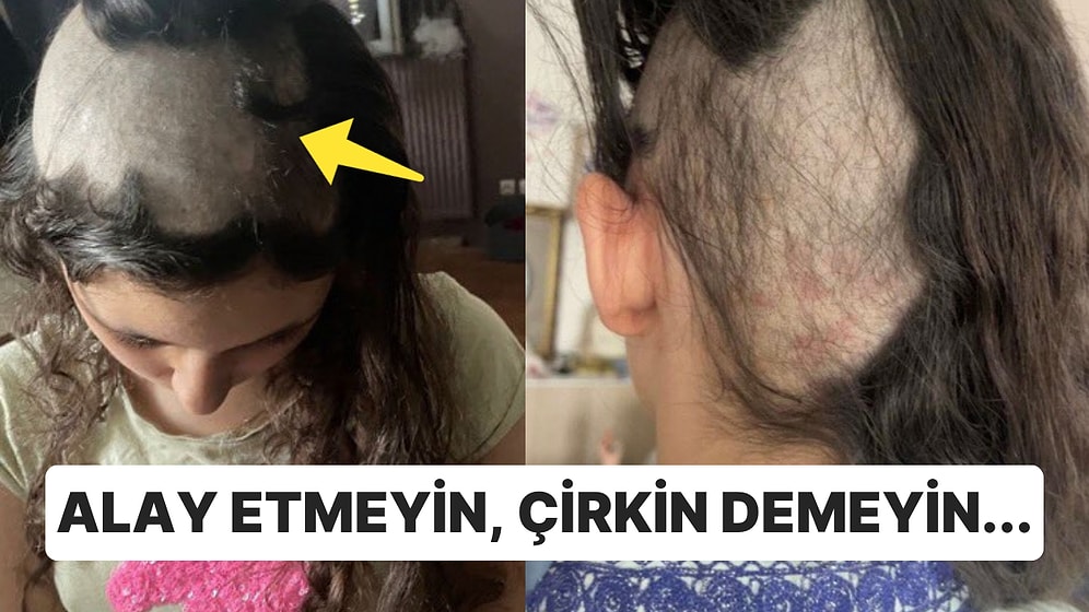 Psikolojik Travma Geçiren İnsanlarda Görülen Saç Yolma Hastalığı Nedir?