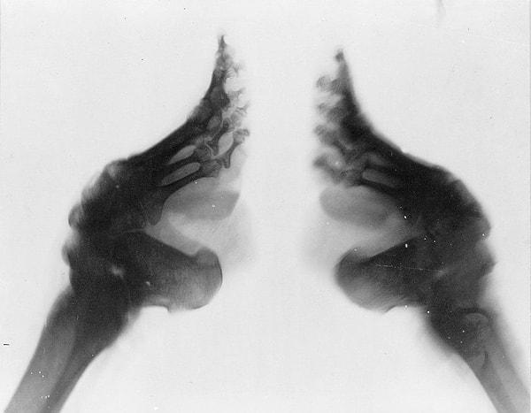 8. "Lotus ayak" denilen bir yöntemle ayakları bağlanan Çinli kadının röntgeni;