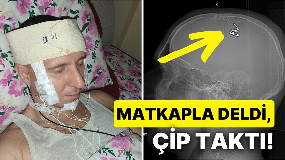 Rusya'da Bir Vatandaş Rüyalarını Kontrol Edebilmek İçin Matkapla Başını Delip Çip Taktı!
