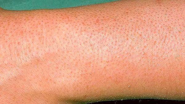 Tavuk derisi görünümü yani keratosis pilaris, en basit diliyle pürüzlü nokta nokta görünen cilt görünümü için kullanılan bir tabirdir.