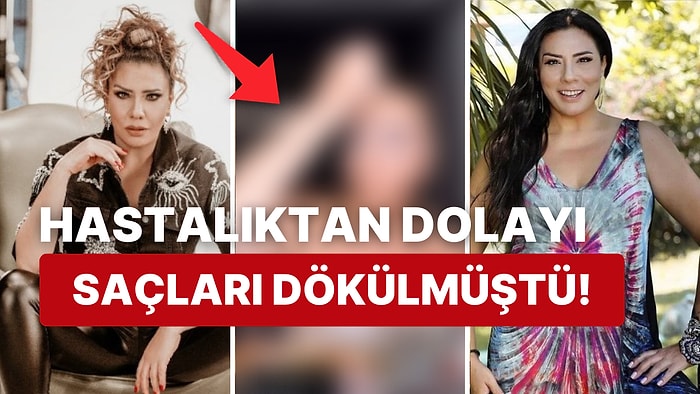 Saçkıran Hastalığına Yakalandığı İçin Sahnelere Perukla Çıkan Işın Karaca, Peruksuz Halini Paylaştı!