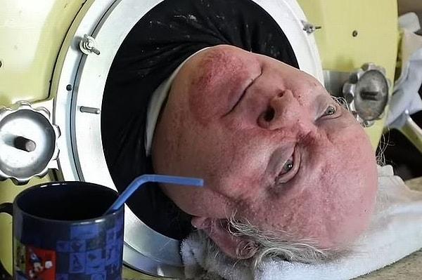Doktorlar o günden bu yana 'çok kısa bir ömrü kaldığını' söylese de 77 yaşındaki Paul Alexander, artık farklı bir yöntemle nefes alıyor.