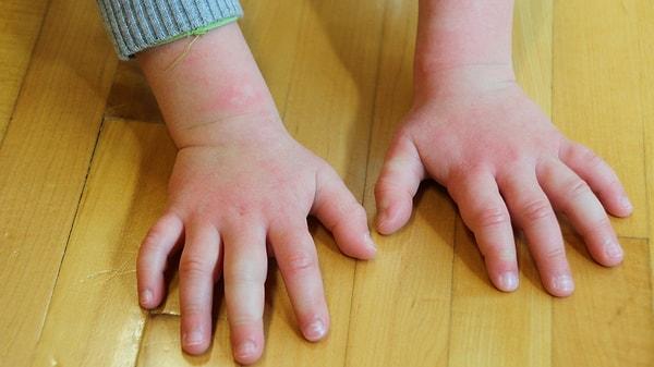 Bebeklik döneminde karşılaşılan alerjik reaksiyonların başında besin alerjisi gelir.