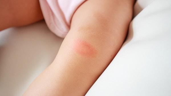 Bebeklerde besin alerjisi belirtileri genellikle hemen ortaya çıkar.