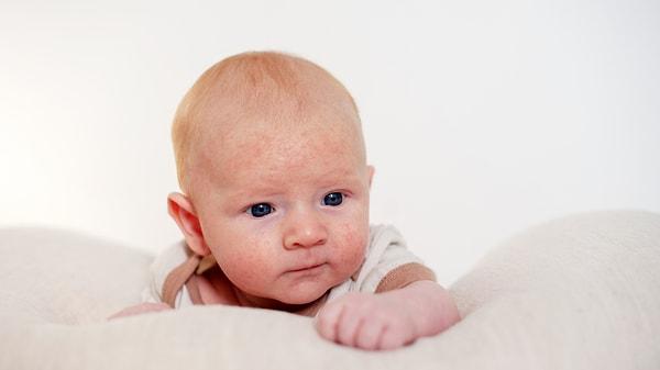 Bebeklerde alerji teşhisi genellikle belirtilerin gözlemlenmesi ve aile öyküsünün incelenmesi ile konulur. Gerekli durumlarda alerji testleri de yapılabilir.