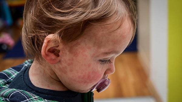 Bebeklerde çikolata alerjisi belirtileri nedir?